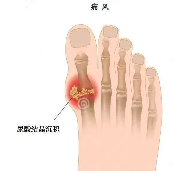 痛風為什么偏愛男性？你最關心的問題都在這里