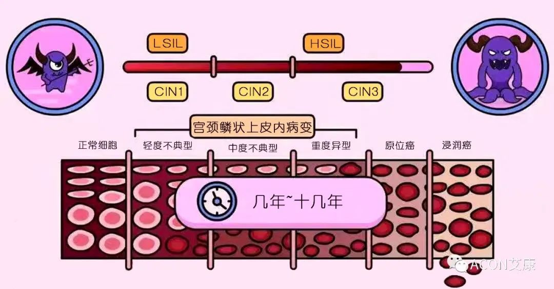 HPV轉(zhuǎn)陰其實(shí)很簡(jiǎn)單， 女性必知的宮頸癌真相