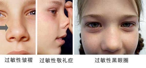 過敏性鼻炎會(huì)讓孩子變傻？！家長該如何應(yīng)對